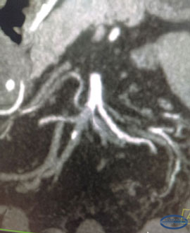 CT images of the embolism of the right branch of the superior mesenteric artery