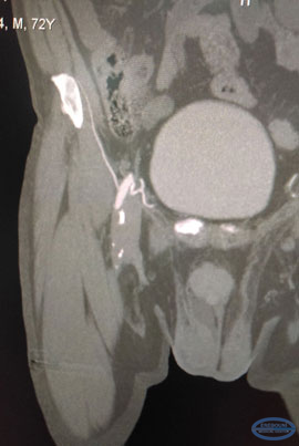  CT images of post infarction cystic formations in the spleen.