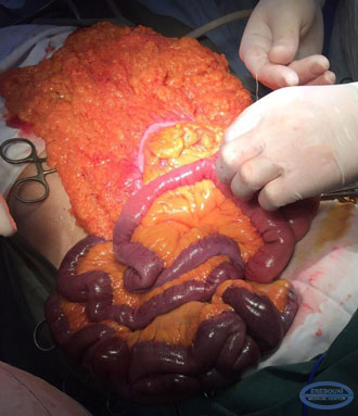   Intraoperative inspection showed necrosis of the distal 2/3 of the jejunum, entire ileal and right half of the colon