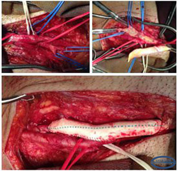   Endarterectomy of the right common and deep femoral artery, profundoplasty with alloy prosthesis