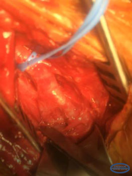 Конечный вид левой ВСА после пластики артериотомии прямым швом.